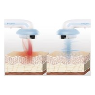 Ultrasound Anti-cellulite Massager for Home Use